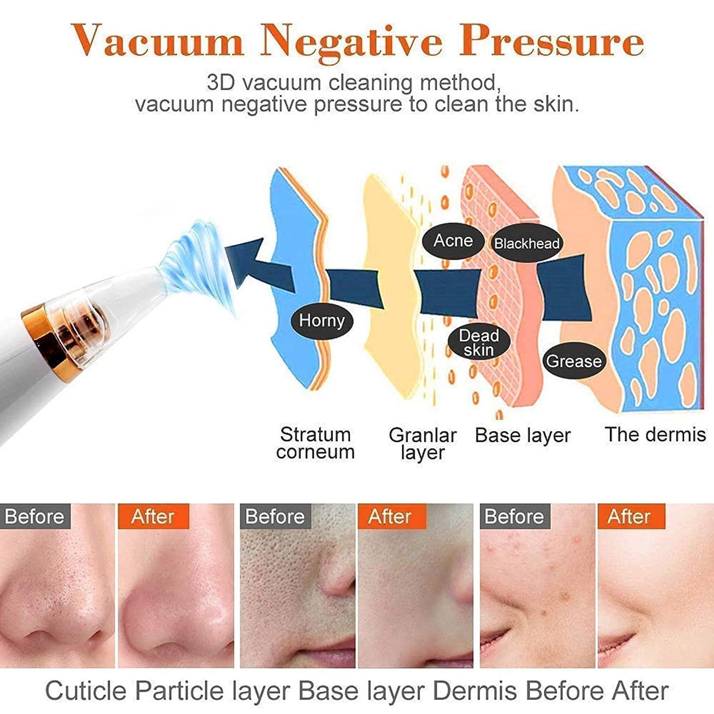 6 in 1 Multi-function Blackhead Remover Tools | Electric Derma suction Machine | USB Rechargeable Acne Pimple Pore Cleaner Vacuum tool | Facial Cleanser Device for Nose & Skin Care