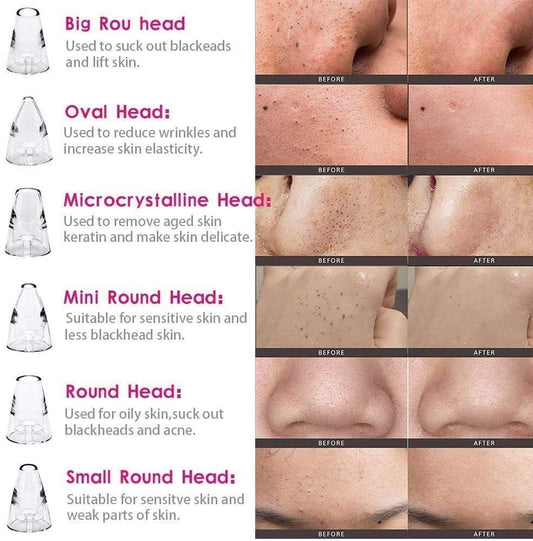 6 in 1 Multi-function Blackhead Remover Tools | Electric Derma suction Machine | USB Rechargeable Acne Pimple Pore Cleaner Vacuum tool | Facial Cleanser Device for Nose & Skin Care